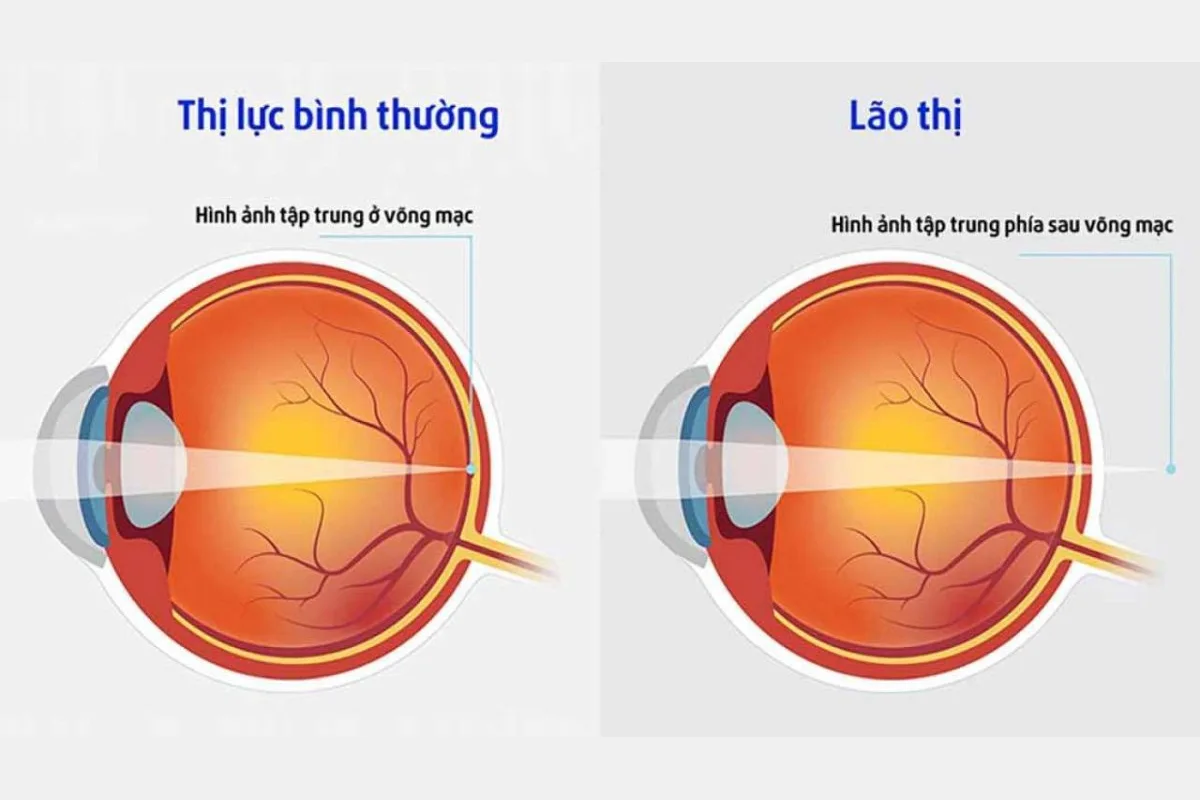 lão thị là gì